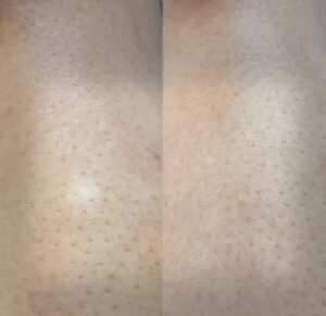 Client undergoing Scar Camouflage treatment for chicken pox scars at Eye Design Studio, NYC.