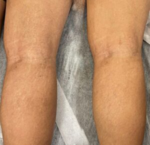 Scar Camouflage procedure blending traumatic scars seamlessly with surrounding skin in NYC.