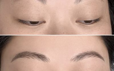 Permanent brows for extreme hair loss