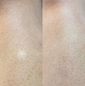 Visible transformation of a C-section scar after Scar Camouflage treatment in NYC.
