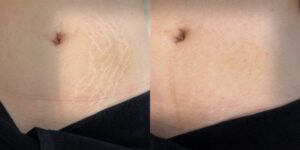 Scar Camouflage procedure subtly blending a C-section scar with the  surrounding skin in NYC.