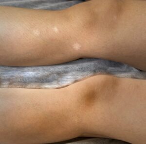 Significant reduction of a tummy tuck scar following Scar Camouflage treatment in NYC.