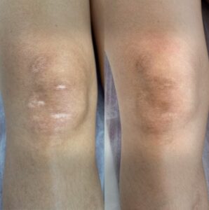Remarkable reduction of a burn scar via Scar Camouflage treatment in NYC