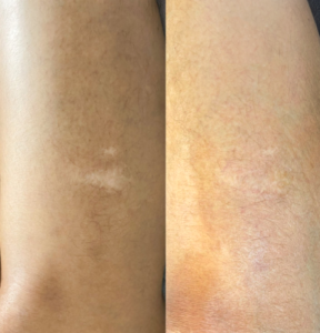 Scar Camouflage procedure blending tattoo scars seamlessly with surrounding skin in NYC.