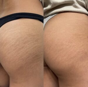 Scar Camouflage procedure blending a burn scar seamlessly with surrounding skin in NYC.