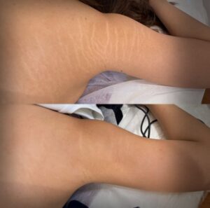 Client undergoing Scar Camouflage treatment for tummy tuck scars at Eye Design Studio, NYC.